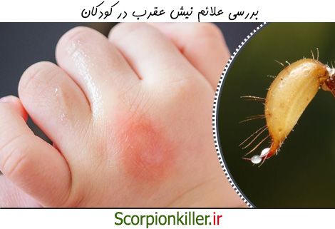 بررسی علائم نیش عقرب در کودکان